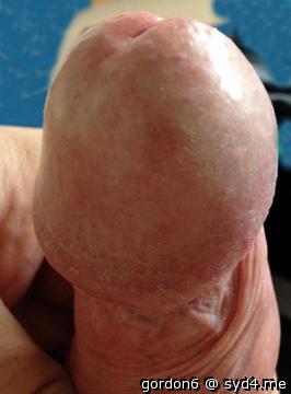 Photo of a penile from gordon6